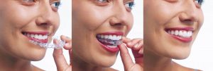 orthodontie adulte invisible