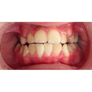 orthodontie invisible bezons