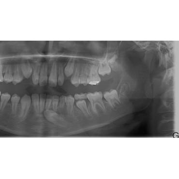 orthodontie adolescents bezons