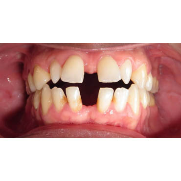 Traitement de diastèmes ou dents écartées par la technique des