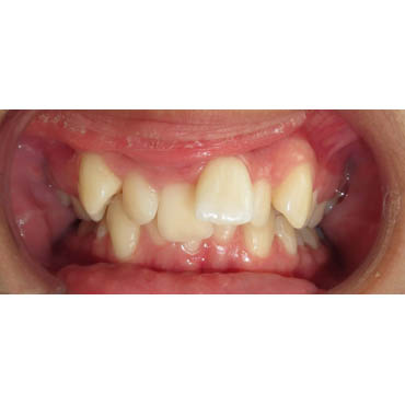 orthodontie adultes bezons