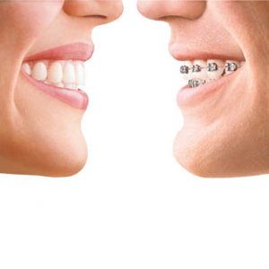 orthodontie adultes bezons