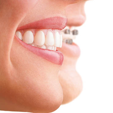 Invisalign, l'appareil dentaire invisible et amovible.