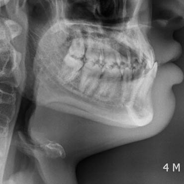 orthodontie esthétique bezons