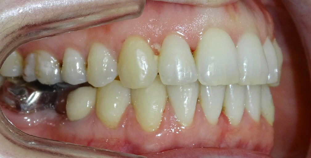 Après : dysharmonie dento-maxillaire, endoalvéolie et surplomb asymétrique adulte de profil