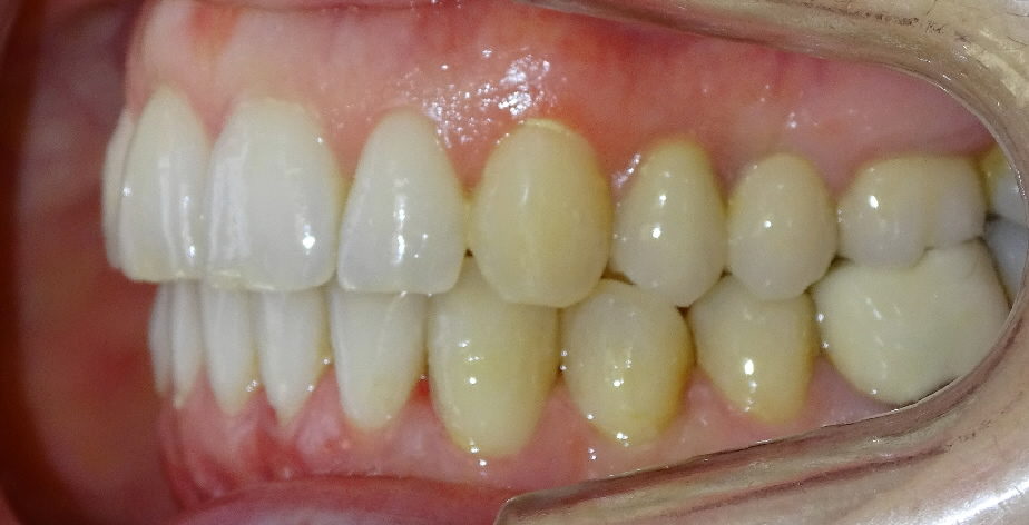 Après : dysharmonie dento-maxillaire, endoalvéolie et surplomb asymétrique adulte de profil