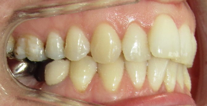 Avant : dysharmonie dento-maxillaire, endoalvéolie et surplomb asymétrique adulte de profil
