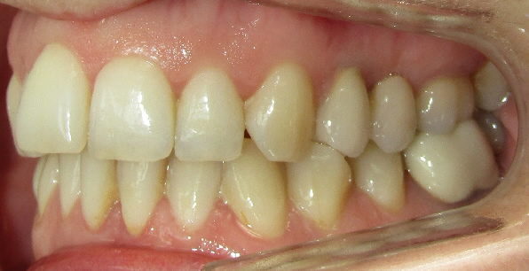 Avant : dysharmonie dento-maxillaire, endoalvéolie et surplomb asymétrique adulte de profil