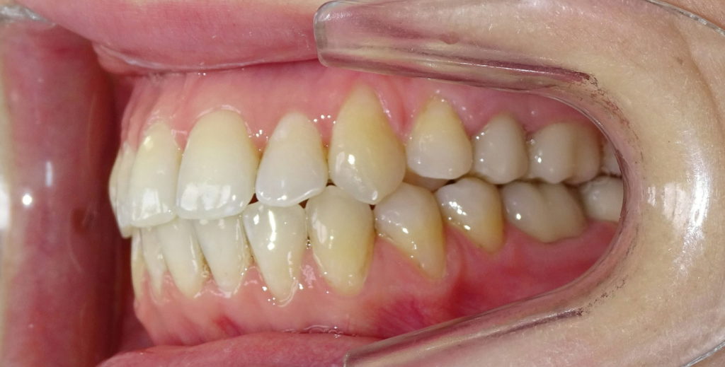 Après : Malpositions dentaires patiente adulte de profil