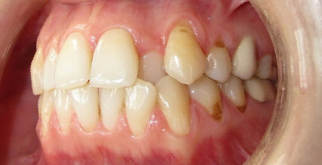 Avant : Malpositions dentaires patiente adulte de profil