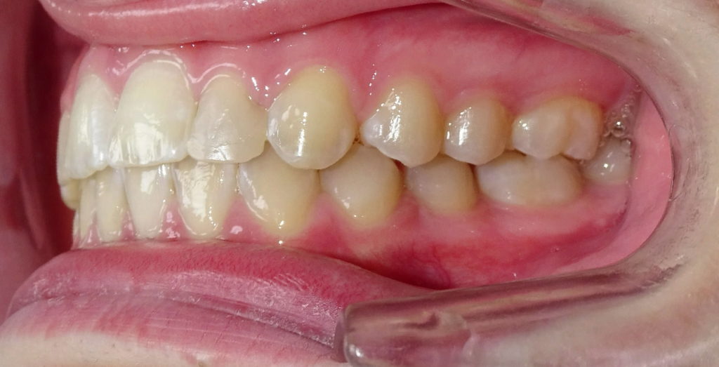 Après : Dysharmonie dento-dentaire associé a des diastèmes généralisés d'une adolescente de profil