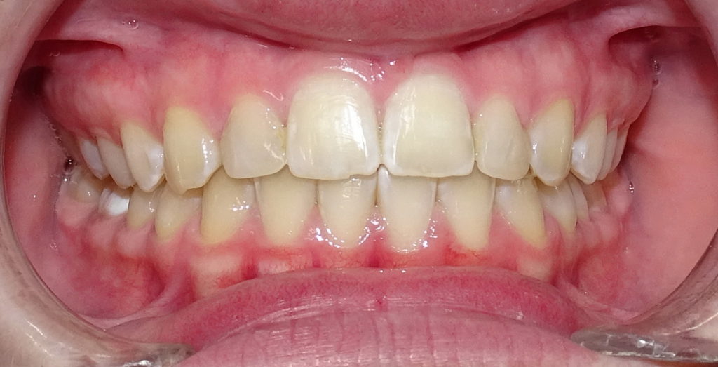 Après : Dysharmonie dento-dentaire associé a des diastèmes généralisés d'une adolescente de face