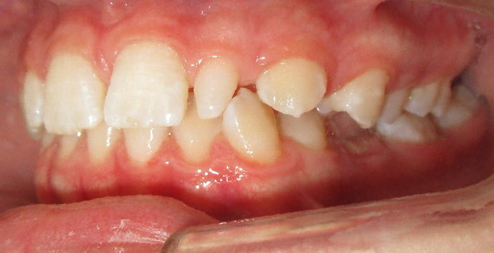 Avant : Dysharmonie dento-dentaire associé a des diastèmes généralisés d'une adolescente de profil