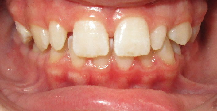 Avant : Dysharmonie dento-dentaire associé a des diastèmes généralisés d'une adolescente de face