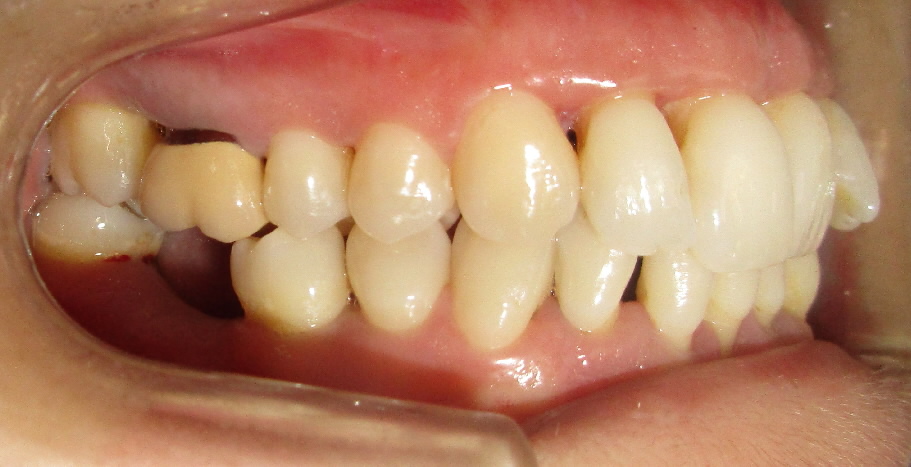 Traitement de diastèmes ou dents écartées par la technique des